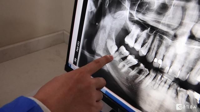 牙齿|只要智齿不疼就不用拔吗？