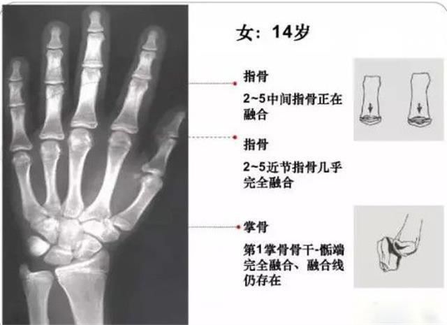 矮骨龄|为什么一定要给孩子测骨龄？孩子长得矮骨龄检测少不了