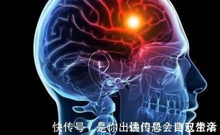 患者|脑中风的3个早期信号!你身边有这些表现吗?