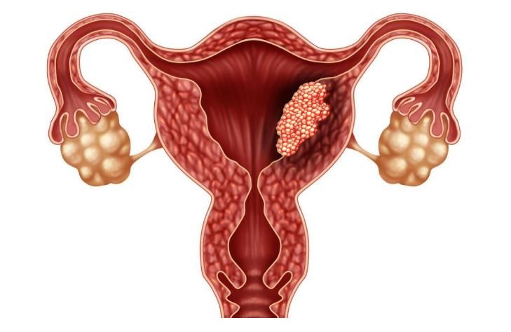 女人|提醒女人：宫颈“生了病”，身体会发出3个“信号”，早查HPV