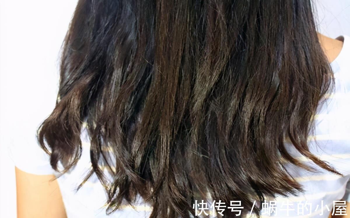 油脂|大把大把的头皮屑,是什么原因?如何才能去除?医生告诉你