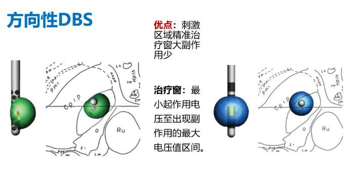 解放军总医院|【患者招募】“方向性电极脑起搏器”治疗帕金森，临床招募中！