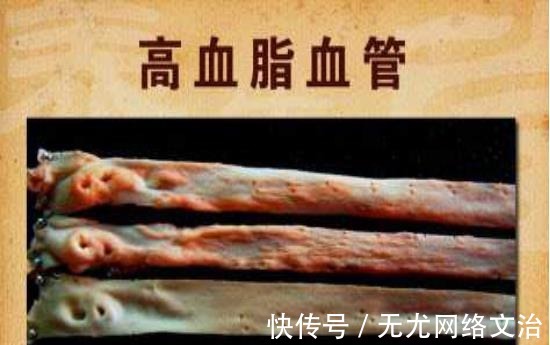 克星|高血脂“克星”公开,避免做这几件事,血管干净通畅