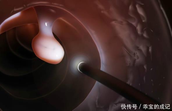 刘医师|四部分的息肉，最好及时切除，癌症可能会出现很长一段时间！