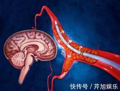 脖子|血栓“潜伏”在脑时,脖子先知道!脖子出现3异常,不要拖