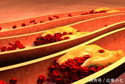 助于|血管“清道夫”找到了!洋葱排第三,排在第一的常被很多人忽视