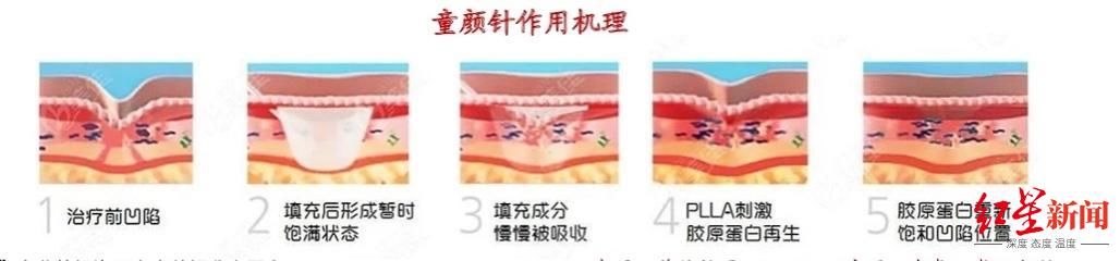 再生时代|童颜针来了，注射医美进入“再生时代”？专家：效果有待验证