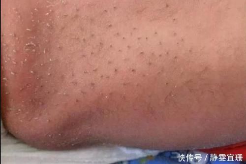 拔掉|宝宝身上出“黑刺”,妈妈全部拔掉后宝宝发烧,医生怒斥宝妈无知