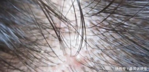 油脂|头皮上长出“小疙瘩”,可能是有大问题,为了家里人健康了解下!
