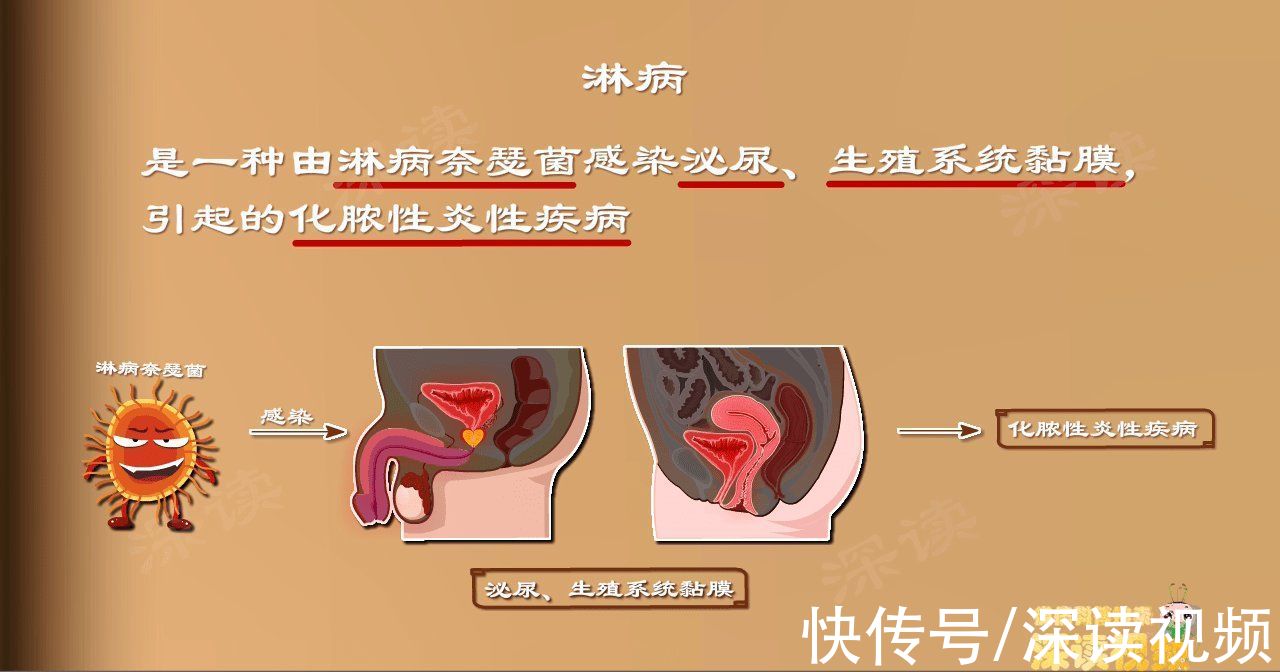 奈瑟菌|我国每年淋病新发病例13万，稳居性病热搜榜Top5！淋病到底是个啥