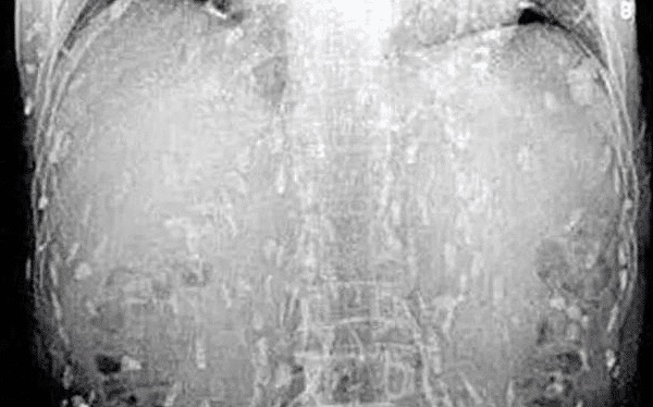 虫子|90后女大学生全身长满虫子,疼痛难忍送医时,医生却破口大骂