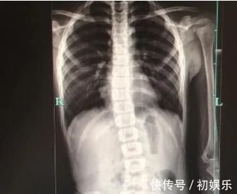 一肩|8岁男孩脊椎侧弯,只因家人常做这个动作,这个错误,90%的父母都在犯