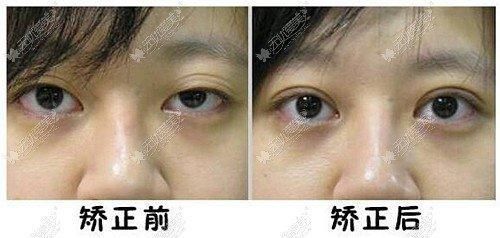 下垂|上眼皮下垂做额肌瓣悬吊术改善能管几年?术后会出现闭不上眼的情况吗