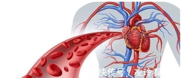 血栓类|小心!糖尿病会并发致命心梗,早期预防很关键