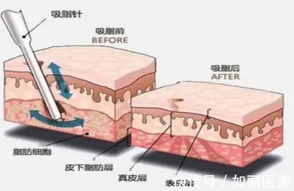 医生 抽脂手术大概花多少钱？附价格表2022一览+危害盘点！