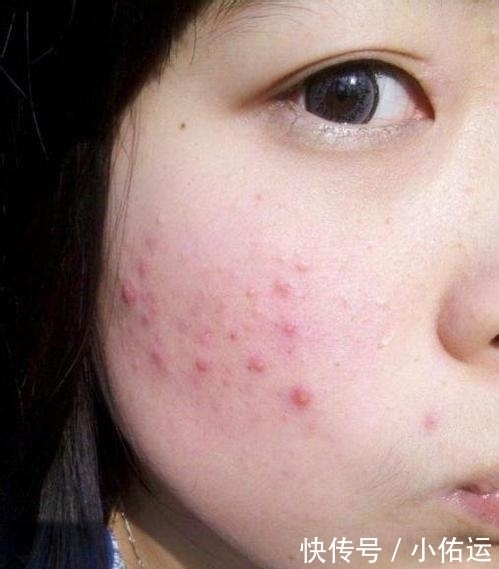 床上螨虫成窝教你一个土方子,让螨虫无所遁形