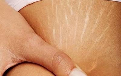 皮肤|准妈妈如何祛除妊娠纹?