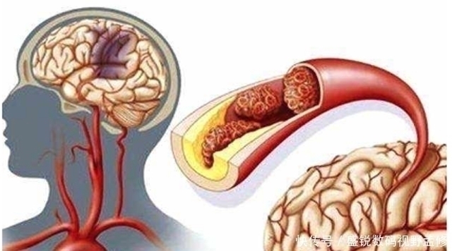 姬松|脑部供血不足，如少做2件事，养成3习惯，脑血管或可干净畅通