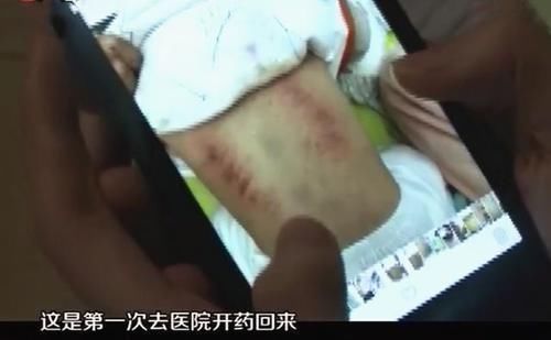 店员|女子带孩子药浴治感冒,洗了三次后背全是红斑血迹,店员:是排毒