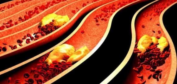 脂质|比糖和盐还可怕的调料,中老年人天天吃,易血管堵塞,血液稠如粥