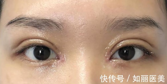 切口 双眼皮越宽眼睛就越大吗?医生揭开双眼皮手术的5个“真相”!