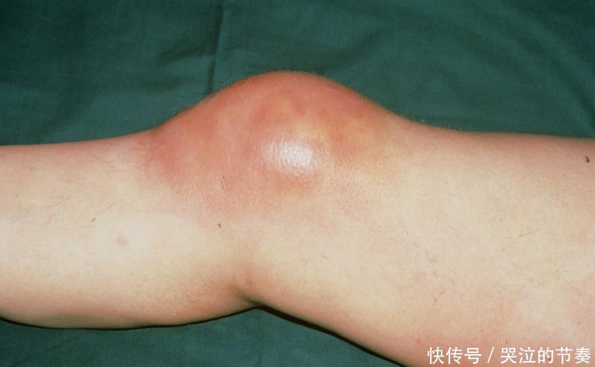 中老年人|51岁阿姨“滑膜炎”离世，医生直言厨房1种调料，没少害了人