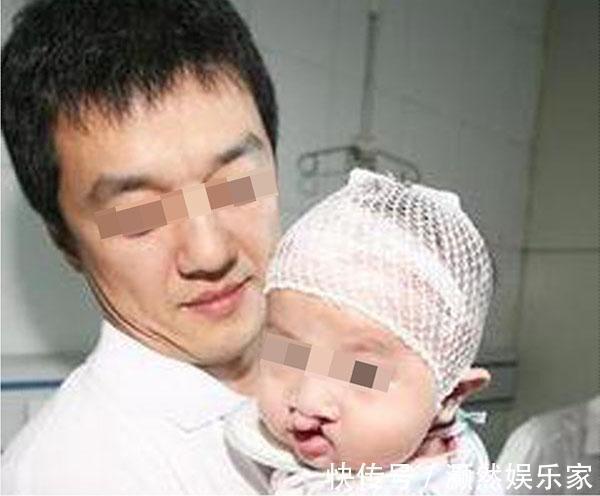 孕期|医生三类孕妇容易生“兔唇”宝宝,如果你在其中,就要小心了