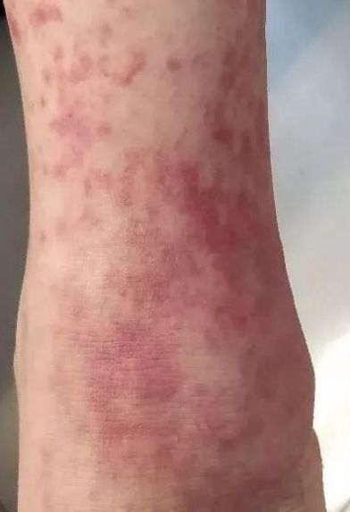 过敏性紫癜是过敏吗 快资讯