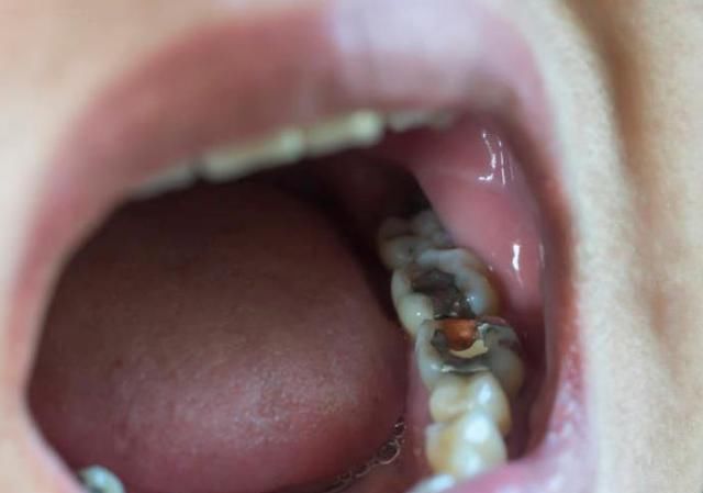 龋齿|10个5岁儿童中，7个有龋齿，罪魁祸首居然不是糖？