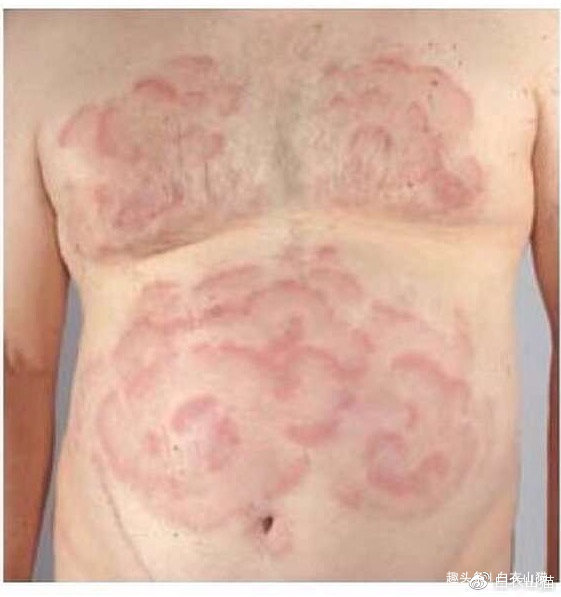 病人|注意，如有人出现这种皮纹，往往提示他内脏有癌！