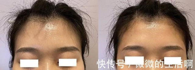 泪沟 别拿宝贵的脸去“试错”,医美项目得这么选(医生经验总结)!