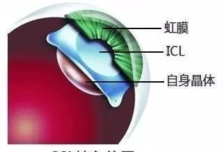 手术|高度近视人群的摘镜优选ICL晶体植入术“过人之处”你知道吗