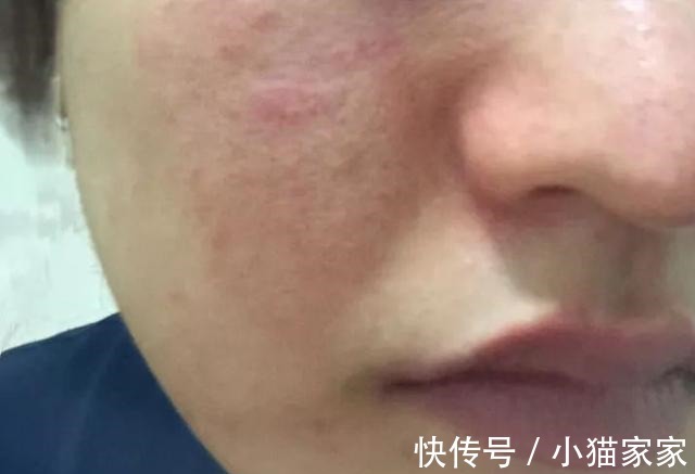 护肤品 哪些皮肤问题是护肤品不能解决的!