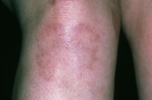 肾脏|什么是尿毒症?尿毒症是怎么引起的?尿毒症可以治愈吗?