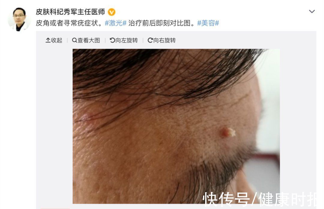 尖锐湿疣|身上莫名长出的"小肉揪揪",是感染了病毒?一篇文章全说清楚