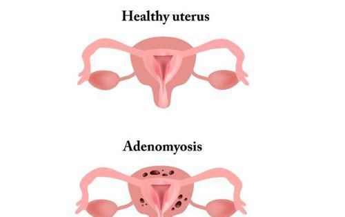  捣乱|女性腰疼无法改善，除了腰部问题，警惕背后是这4种妇科病在捣乱