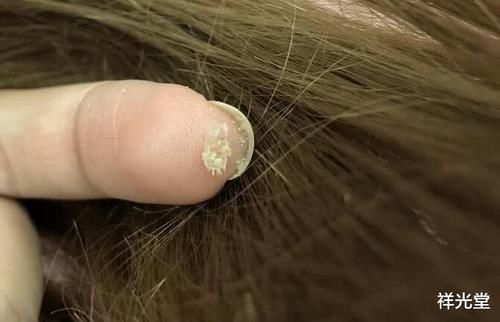 洗头|头没洗两天,指甲缝总能抠出“白泥”,原因简单,很多人容易忽视