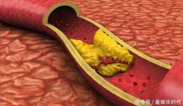 害怕|高血脂“害怕”的几种食物,每天吃一些,有助疏通血管,预防血栓