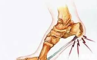 褚实子|骨质增生必看!一个非常强大快要失传的方子,2味药治好5年足跟痛