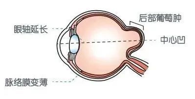 防范|权威提醒:近视度数不断增加或致盲,高度近视需引起重视和防范