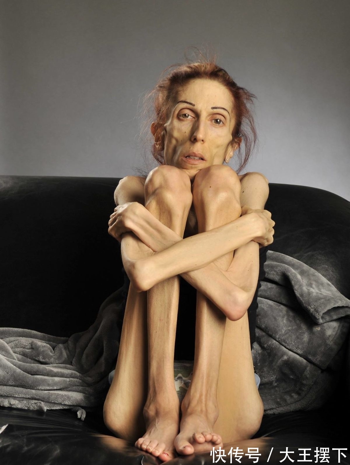 丈夫|妻子瘦到只有30斤,丈夫每天强迫她吃肉,如今发生翻天覆地的变化