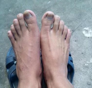 张医师|当血管堵塞时，脚部可能会发出信号，你若没有，表明血栓离你还远