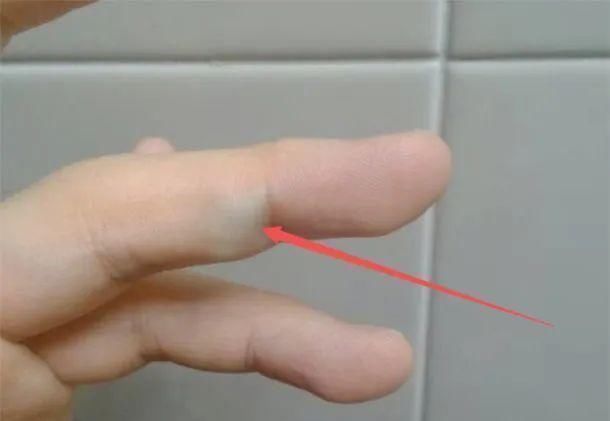 中指|手有这“4种变化”,提醒你“大病”来了,需尽早就医,千万别拖