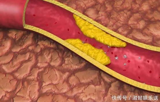 血液循|高血脂“害怕”2件事,你若能坚持,血管一天比一天干净