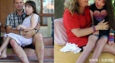 子宫|为了让女儿停止发育,父母切除了她的子宫,称这是对她最大的保护