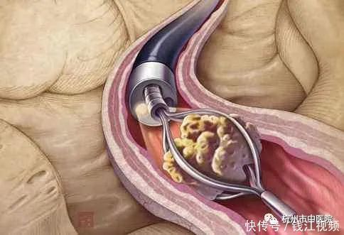 疯狂|从“疯狂的石头”到一口袋碎石子再到脓毒血症,这都经历了什么啊