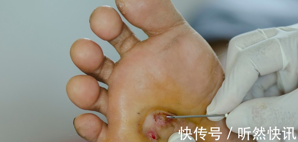 间歇性跛行|糖尿病足是每个糖友的“噩梦”!医生提醒出现4个症状就该警惕