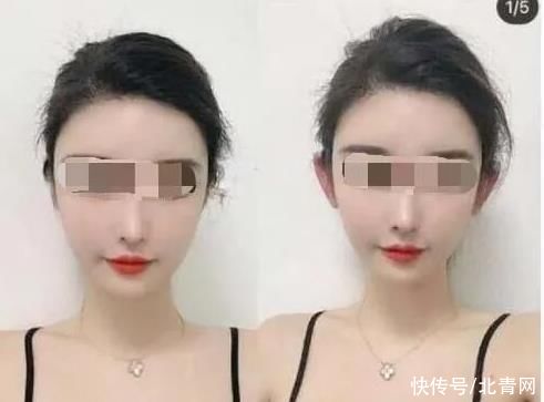 精灵耳|多家整形机构推“精灵耳”变美？专家：或整成畸形