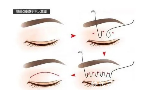 埋线双眼皮 割双眼皮需要多少钱?原来手术方式不一样价格也不同!快来看看你割双眼皮需要多少钱?