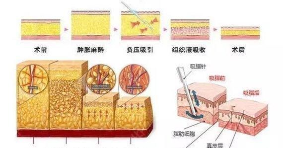 注意事|酷塑和吸脂哪个好酷塑术后注意事项有哪些